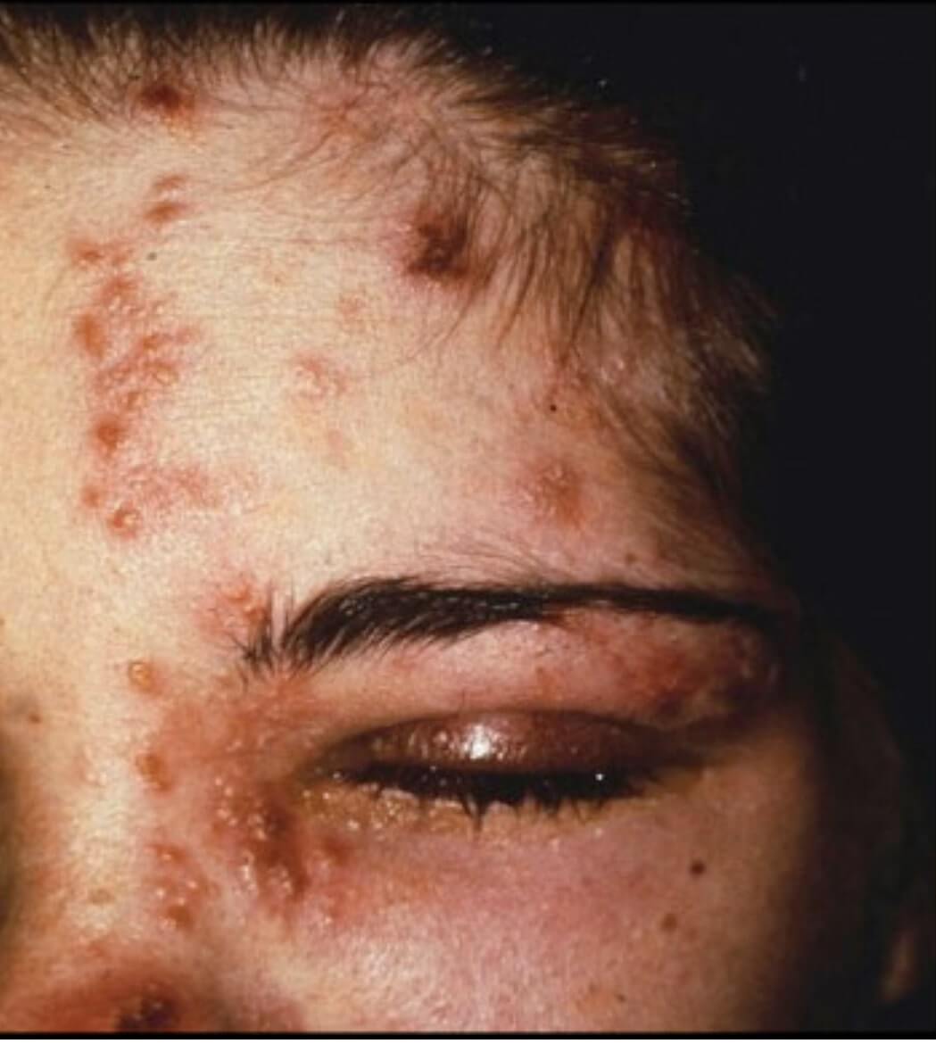 帯状疱疹の症状・治療・ワクチンなどについて医学的データを交えて詳しく解説